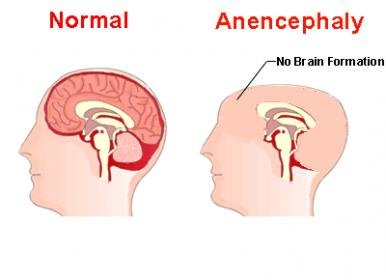 anencephaly1.jpg