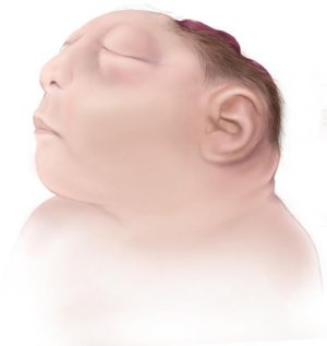 anencephaly-web.jpg