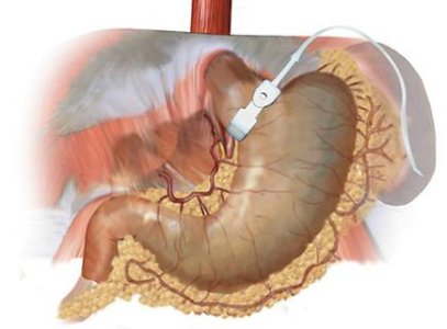 lapband.jpg lapband.jpg