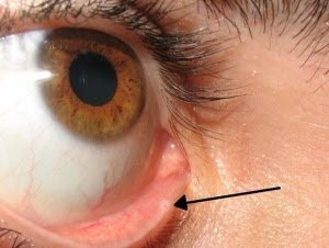 300px-Lacrimal_punctum.jpg