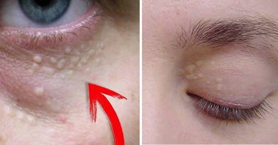 deposito-colesterolo-occhi-xantelasma.jpg