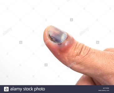 bruise-nail-from-accident-of-male-hand-isolated-on-white-background-M17DRD.jpg
