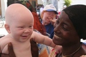 Mother-and-albino-child-300x199.jpg