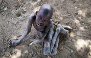 Nodding+Disease-300x190.jpg Nodding+Disease-300x190.jpg